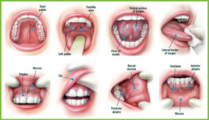 Oral Cancer