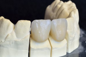 Dental Crowns