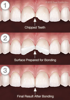 How to Fix a Chipped Tooth with a Cosmetic Dentist