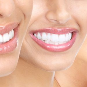 teeth_whitening