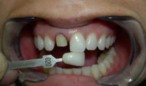 Recement Dental Veneer