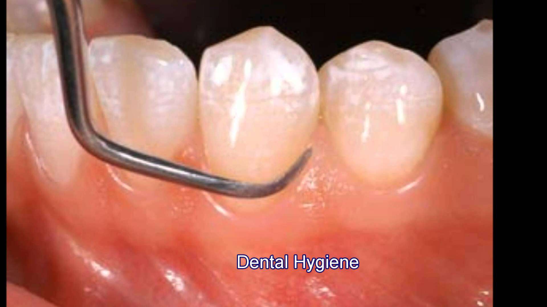Dental Cleanings Don t Be Afraid Los Angeles Cosmetic Dentist