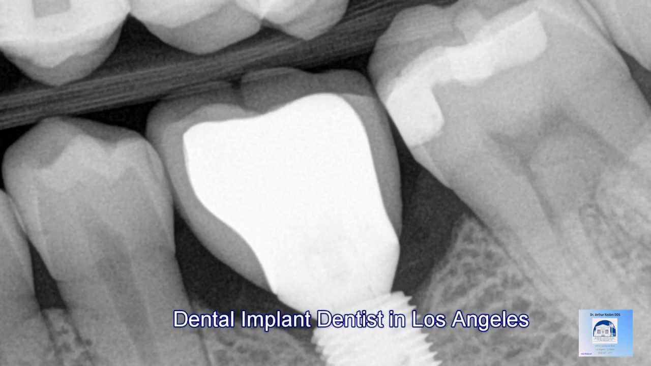 dental-implants-how-they-can-cha.jpg