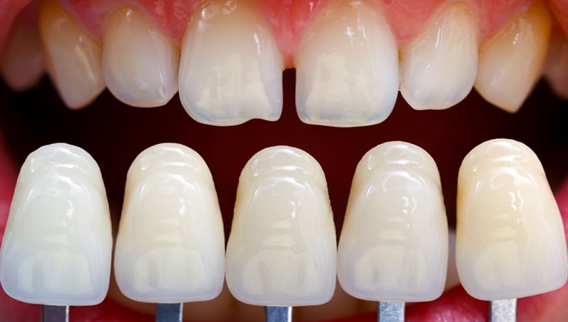 How Much Do Veneers Cost The Lowdown On Porcelain Veneers