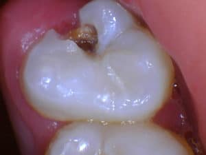 Cracked Tooth