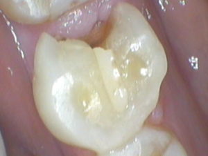 Cracked Tooth