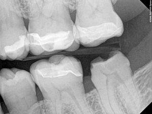 recementing a dental crown