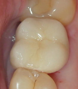 Cost of Dental Porcelain Crowns