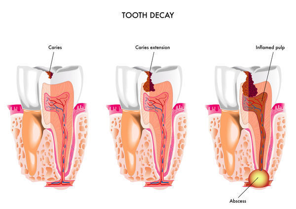 Tooth Ache