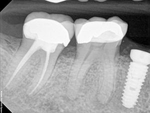 Dental Implants