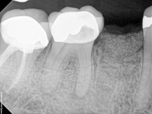 Implant Dentist Los Angeles