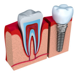 Implant Dentist