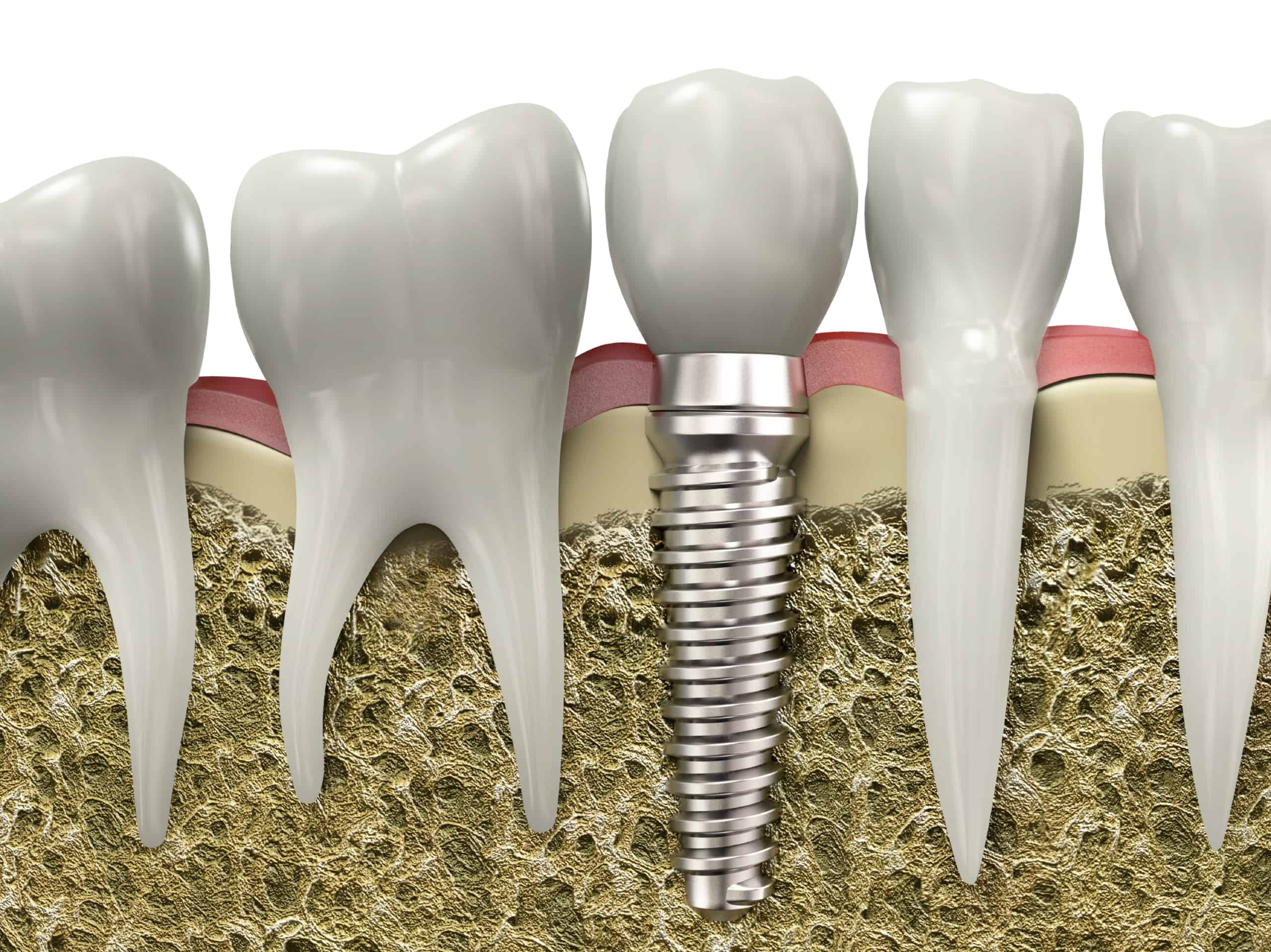 Implant Dentistry | Five Must-Ask Questions for An Implant Dentist