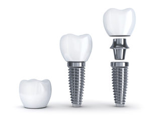 Implant Dentist