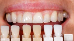 dental veneers