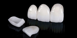 Porcelain Veneers