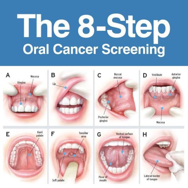 Oral Cancer