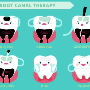 Root Canal