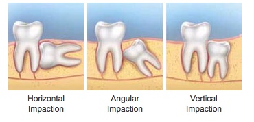 Wisdom Teeth