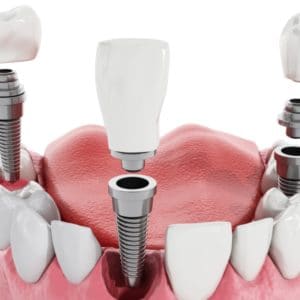 Implant Dentist