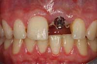 dental implant