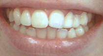 Porcelain Dental Veneers