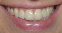 Porcelain Dental Veneers After