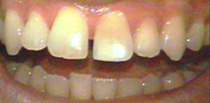 Porcelain Dental Veneers