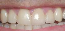 Porcelain Dental Veneers After