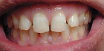 Porcelain Dental Veneers