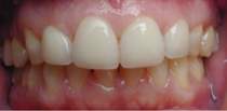 Porcelain Dental Veneers After