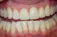 dental bleaching