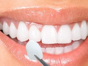 White teeth, Dental Veneers Los Angeles, hollywood smile