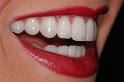 Dental Veneers, Porcelain, Smile