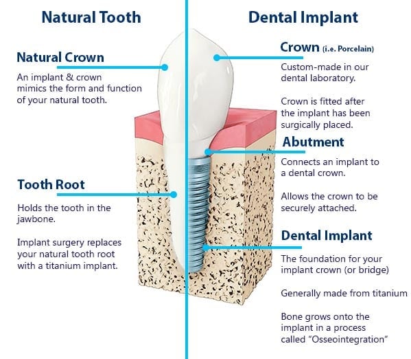 Dental Implant