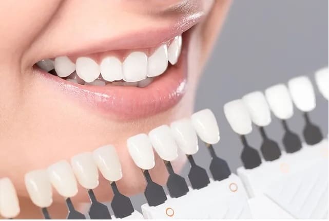 Advantages of Dental Veneers from LA's Best Cosmetic Dentist