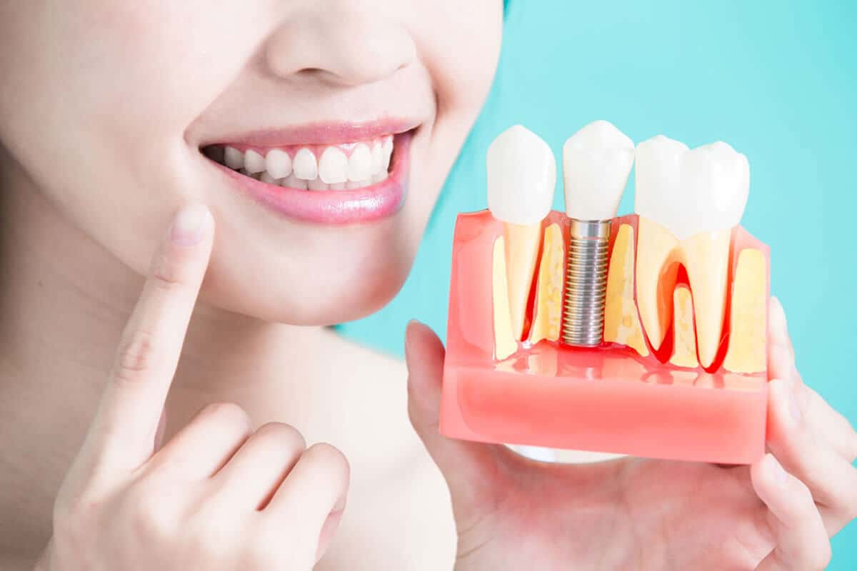 Bridge-Vs.-Dental-Implant-%E2%80%93-Which-one-is-right-for-you-1.jpg